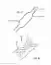 Fig. 13 - METHODS OF TREATING A CONDITION OF A VESSEL IN A PATIENT