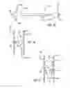 Fig. 22 - METHODS OF TREATING A CONDITION OF A VESSEL IN A PATIENT