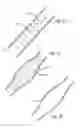 Fig. 10 - INTRALUMINAL SCAFFOLD WITH CONFORMING AXIAL STRUT