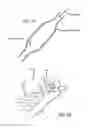 Fig. 13 - INTRALUMINAL SCAFFOLD WITH CONFORMING AXIAL STRUT