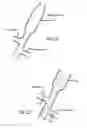 Fig. 17 - INTRALUMINAL SCAFFOLD WITH CONFORMING AXIAL STRUT