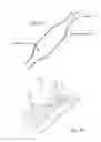 Fig. 13 - METHOD OF DELIVERING A MEDICAL DEVICE ACROSS A VALVE