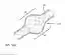 Fig. 14 - METHOD OF DELIVERING A MEDICAL DEVICE ACROSS A VALVE