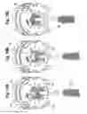 Fig. 07 - Color-coded prosthetic valve system and methods for using the same