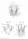 Fig. 02 - Valve prosthesis fixation techniques using sandwiching