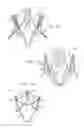 Fig. 03 - Valve prosthesis fixation techniques using sandwiching