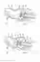 Fig. 09 - Valve prosthesis fixation techniques using sandwiching