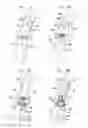 Fig. 13 - Valve prosthesis fixation techniques using sandwiching