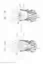 Fig. 16 - Valve prosthesis fixation techniques using sandwiching