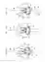 Fig. 24 - Valve prosthesis fixation techniques using sandwiching