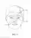 Fig. 02 - TREATMENT OF NASAL CAVITIES WITH STENT HAVING A SOFT OUTER LAYER