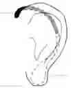 Fig. 01 - EAR LOBE SUPPORT FOR HEAVY EARRINGS WEARERS