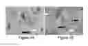 Fig. 02 - Identification of high grade or ≧ CIN2 for early stages and late stages detection, screening, and diagnosis of human papillomavirus (HPV) and HPV-associated cancers