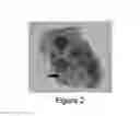 Fig. 03 - Identification of high grade or ≧ CIN2 for early stages and late stages detection, screening, and diagnosis of human papillomavirus (HPV) and HPV-associated cancers