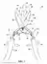 Fig. 02 - Bird debreasting tool and methods