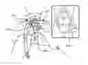 Fig. 01 - Centering aid for implantable sling