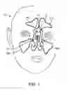 Fig. 02 - Devices and methods for inserting a sinus dilator