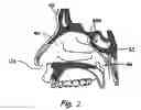 Fig. 03 - Devices and methods for inserting a sinus dilator