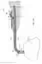 Fig. 12 - Devices and methods for inserting a sinus dilator