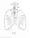 Fig. 16 - Catheter Having Needle And Expandable Support Member And Methods Of Use