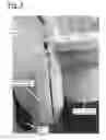 Fig. 08 - Bladder driven linear cylinder and associated devices driven thereby