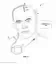 Fig. 02 - Therapy for rapid eye movement behavior disorder (RBD)
