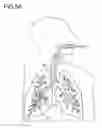 Fig. 13 - Method for treatment of emphysema