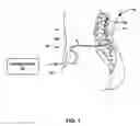 Fig. 02 - Drug infusion device with controllable valve