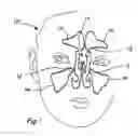 Fig. 02 - Devices and methods for dilating a paranasal sinus opening and for treating sinusitis