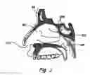 Fig. 03 - Devices and methods for dilating a paranasal sinus opening and for treating sinusitis