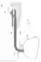 Fig. 15 - Devices and methods for dilating a paranasal sinus opening and for treating sinusitis