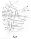 Fig. 06 - Method and apparatus for osteosynthesis