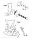 Fig. 03 - Combination male/female hip joint and installation kit