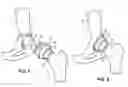 Fig. 06 - Combination male/female hip joint and installation kit