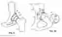 Fig. 07 - Combination male/female hip joint and installation kit