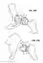Fig. 08 - Combination male/female hip joint and installation kit