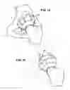 Fig. 11 - Combination male/female hip joint and installation kit