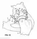 Fig. 13 - Combination male/female hip joint and installation kit