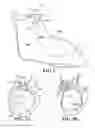 Fig. 02 - Implants, surgical methods, and instrumentation for use in femoroacetabular impingement surgeries