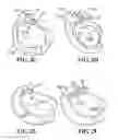 Fig. 03 - Implants, surgical methods, and instrumentation for use in femoroacetabular impingement surgeries