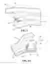 Fig. 04 - Implants, surgical methods, and instrumentation for use in femoroacetabular impingement surgeries