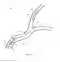 Fig. 09 - Medical snare device