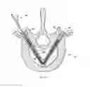 Fig. 33 - Apparatus and methods for bone, tissue and duct dilatation