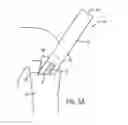 Fig. 05 - Pressure cuff holding device