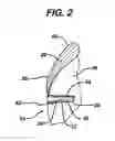 Fig. 03 - Knotless suture anchor