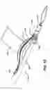 Fig. 09 - Knotless suture anchor