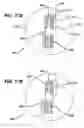 Fig. 16 - Knotless suture anchor