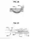 Fig. 20 - Knotless suture anchor and driver
