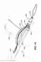 Fig. 09 - Anchor driver with suture clutch