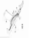 Fig. 09 - Knotless suture anchor with unthreaded nose